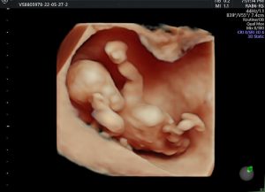 siêu âm thai nhi 11 tuần tuổi