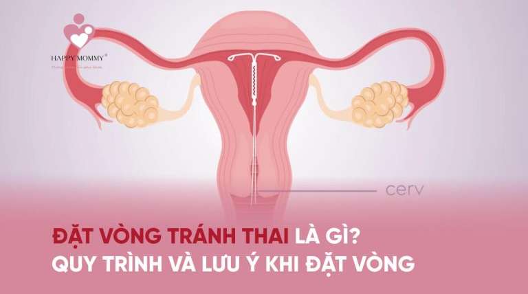 Đặt vòng tránh thai là gì? Quy trình và lưu ý khi đặt vòng tránh thai