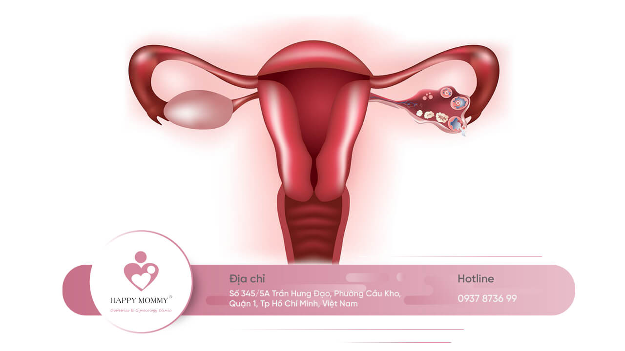 Tắc vòi trứng là hiện tượng vòi trứng bị tắc nghẽn vì nhiều lý do