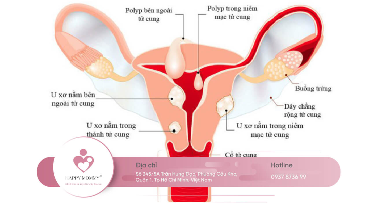 Hiện nay có 3 dạng u xơ tử cung phổ biến, bác sĩ sẽ phân loại dựa trên vị trí phát triển của chúng