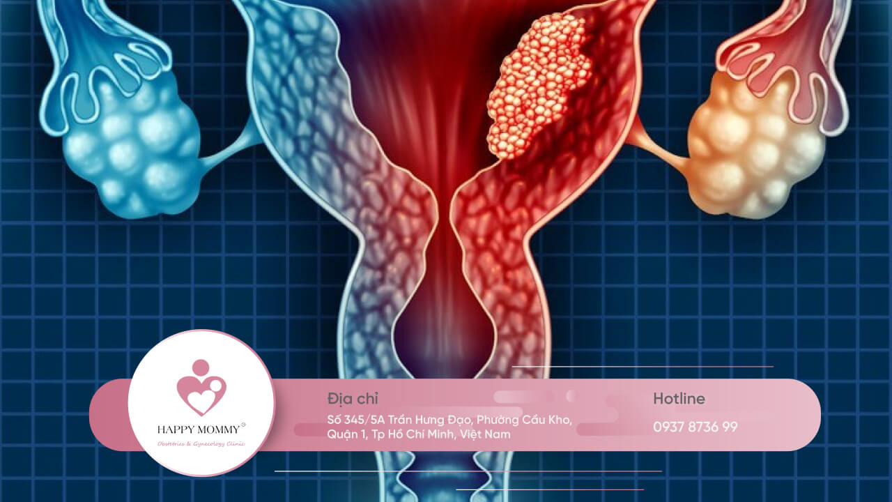 Ung thư biểu mô tế bào vảy là loại thường gặp nhất của ung thư cổ tử cung