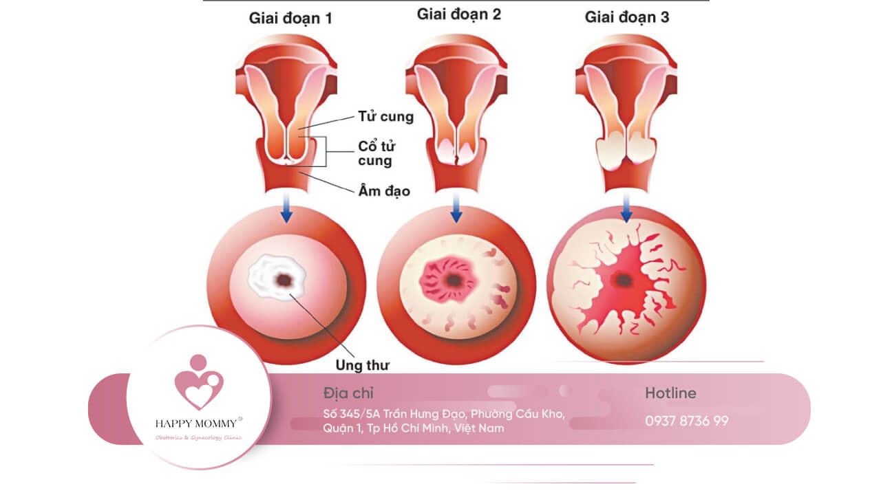 Có 4 giai đoạn ung thư cổ tử cung, trong đó giai đoạn 0 là giai đoạn tiền ung thư, nếu phát hiện sẽ dễ dàng điều trị