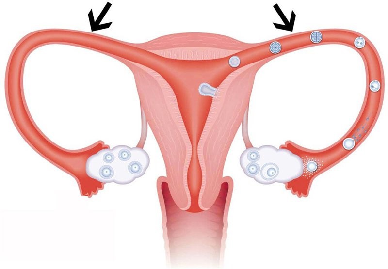Tắc vòi trứng có thể gây vô sinh và thai ngoài tử cung