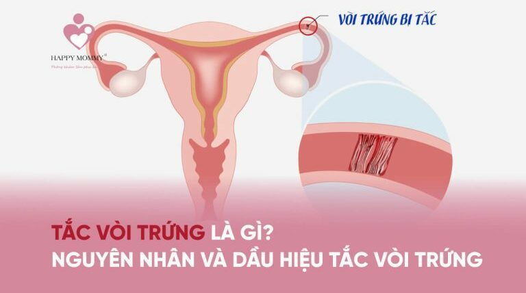 Tắc vòi trứng là gì? Nguyên nhân và dầu hiệu tắc vòi trứng