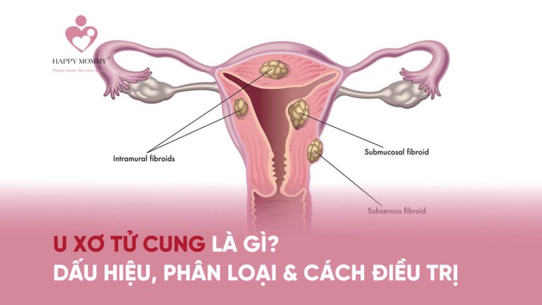 U xơ tử cung là gì? Dấu hiệu, phân loại và cách điều trị bệnh