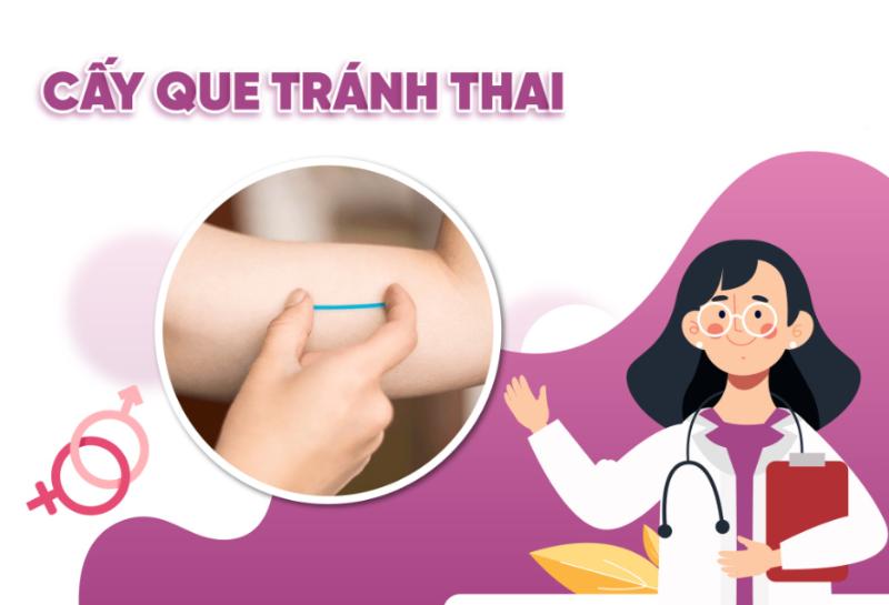 Cấy que phòng tránh thai ức chế quá trình rụng trứng, phòng ngừa mang thai