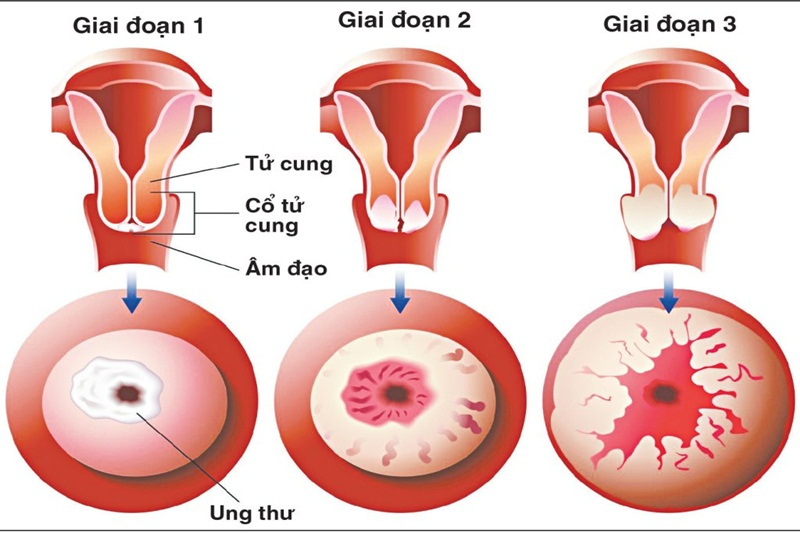 Chích vắc xin HPV có hiệu quả 30 năm trong việc ngăn ngừa ung thư cổ tử cung