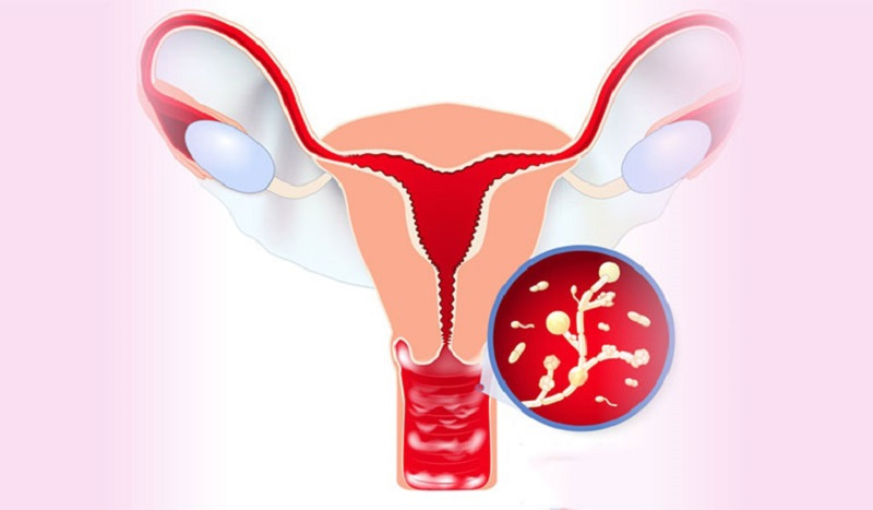 Chụp tử cung vòi trứng có một số biến chứng cần lưu ý sau khi thực hiện 