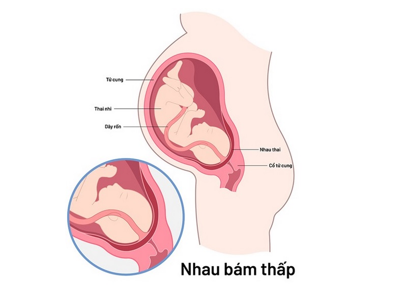 Nhau bám thấp là tình trạng nhau thai bám thấp gần cổ tử cung