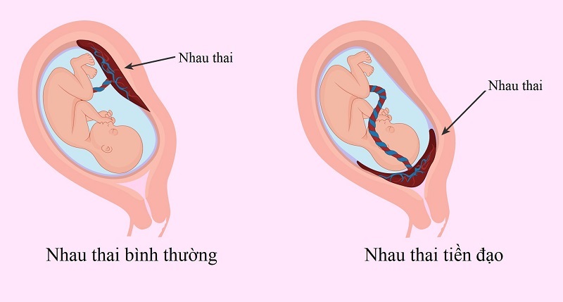 Nhau tiền đạo là tình trạng nhau thai nằm sát dưới tử cung, gần cổ tử cung