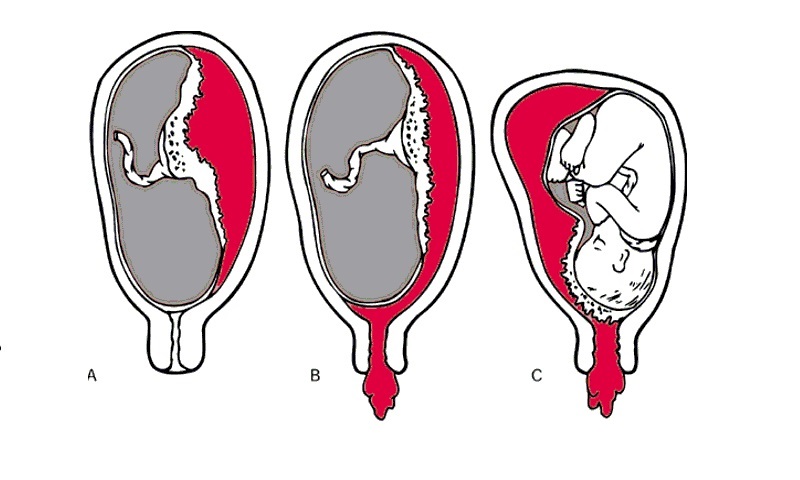 Rau tiền đạo khiến mẹ bầu bị chảy máu bất thường trầm trọng