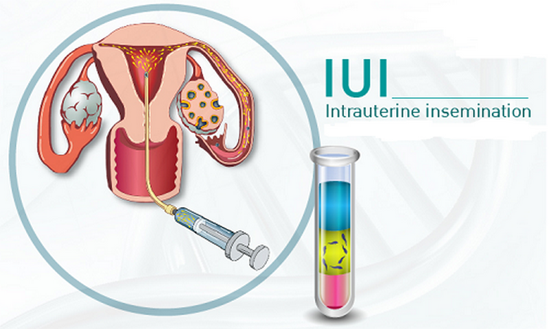 Phương pháp IUI có tỷ lệ thụ thai thành công đến 6 – 26%