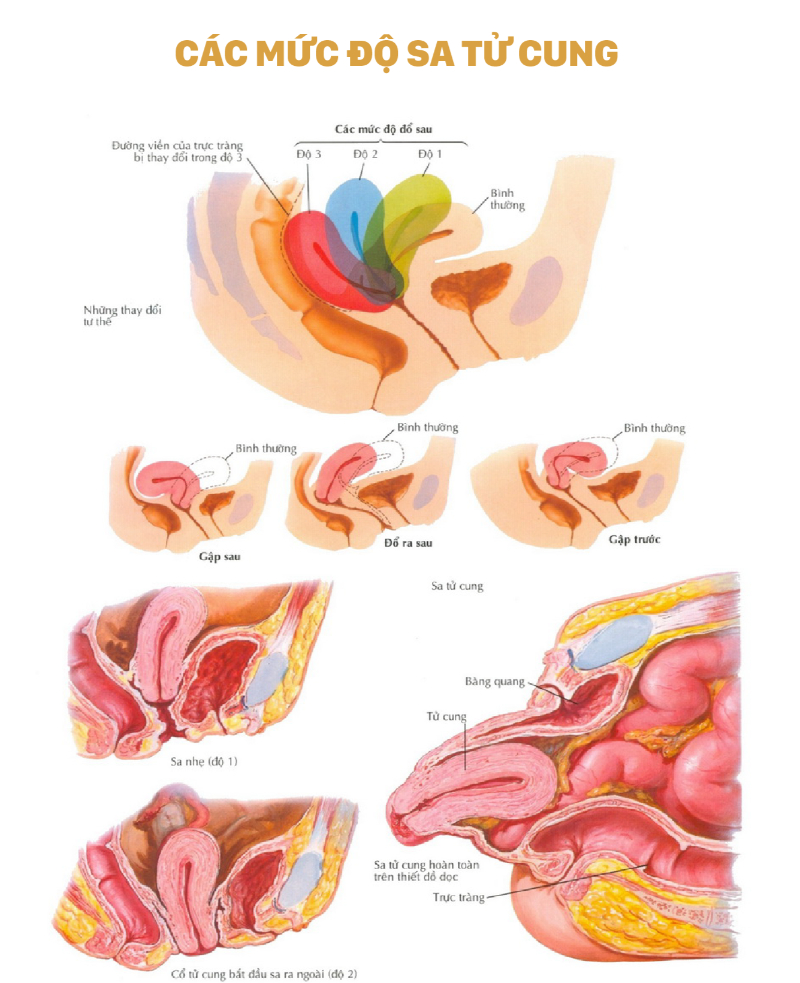 Sa tử cung giai đoạn 4 – giai đoạn nặng và nguy hiểm nhất 
