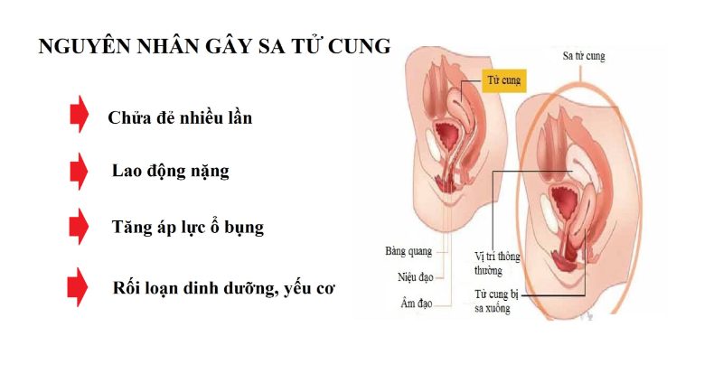 Có nhiều nguyên nhân gây ra sa tử cung sau khi sinh 