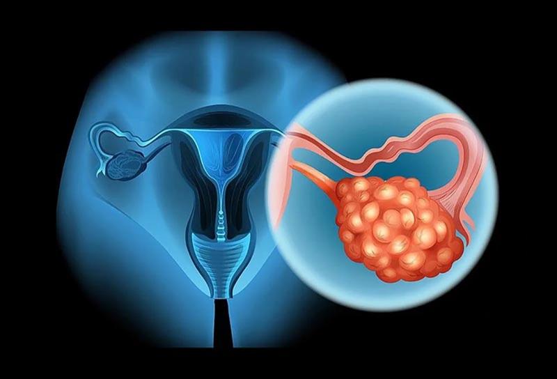 U nang buồng trứng – khối u tích tụ dịch nằm ở bề mặt/ bên trong buồng trứng