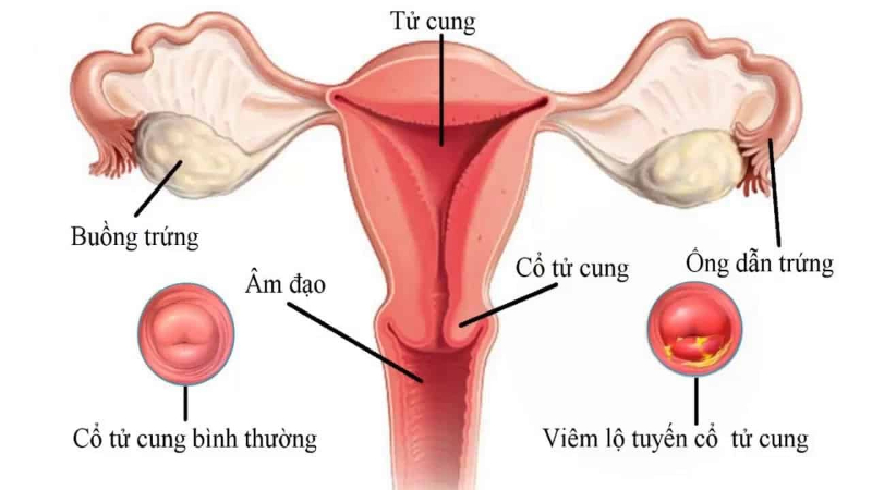 Viêm cổ tử cung là tình trạng cổ tử cung bị sưng tấy, viêm đỏ, mưng mủ