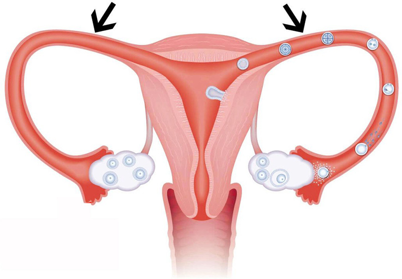 Vòi trứng là đoạn nối giữa buồng trứng và buồng tử cung, chuyên vận chuyển trứng và tinh trùng