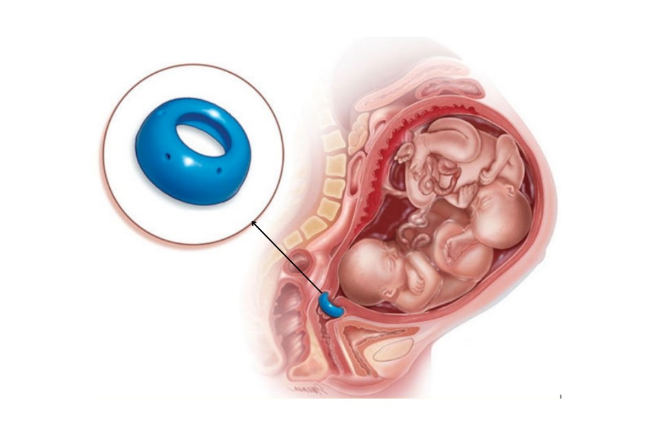  Phương pháp đặt vòng nâng cổ tử cung được sử dụng trong việc dự phòng sinh non