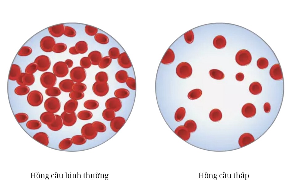 Hồng cầu thấp là tình trạng nồng độ hồng cầu trong máu thấp hơn mức bình thường