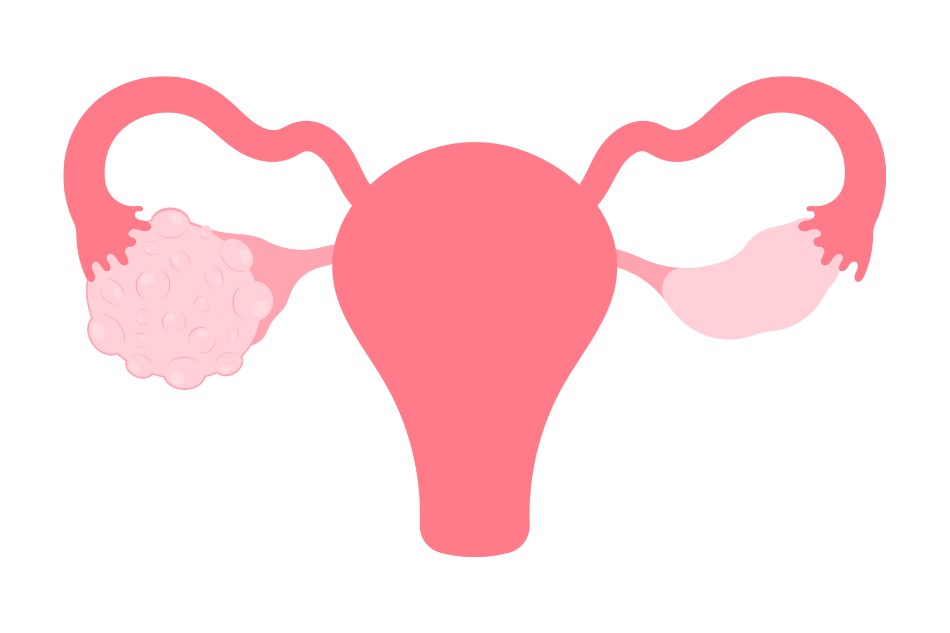 U nang buồng trứng cũng có tình trạng đau bụng dưới sau quan hệ