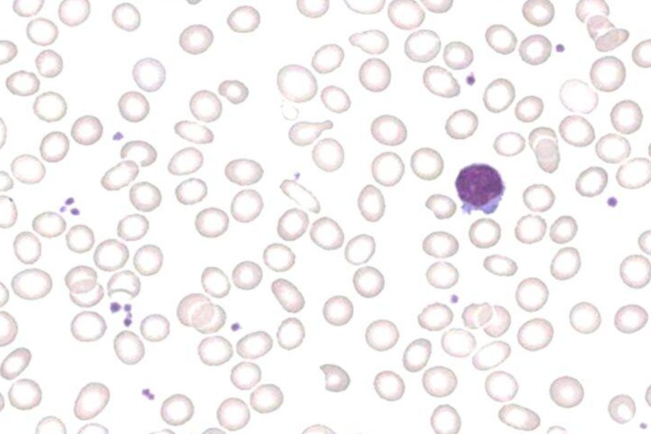 Thiếu máu hồng cầu nhỏ nhược sắc là gì?